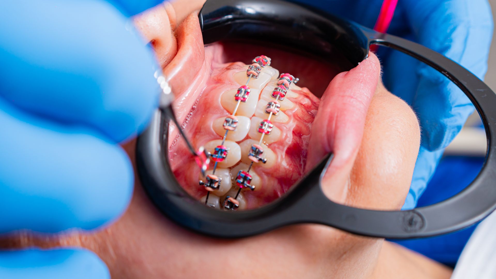 Braces treatment in Dharamshala at Floss & Gloss Aesthetics