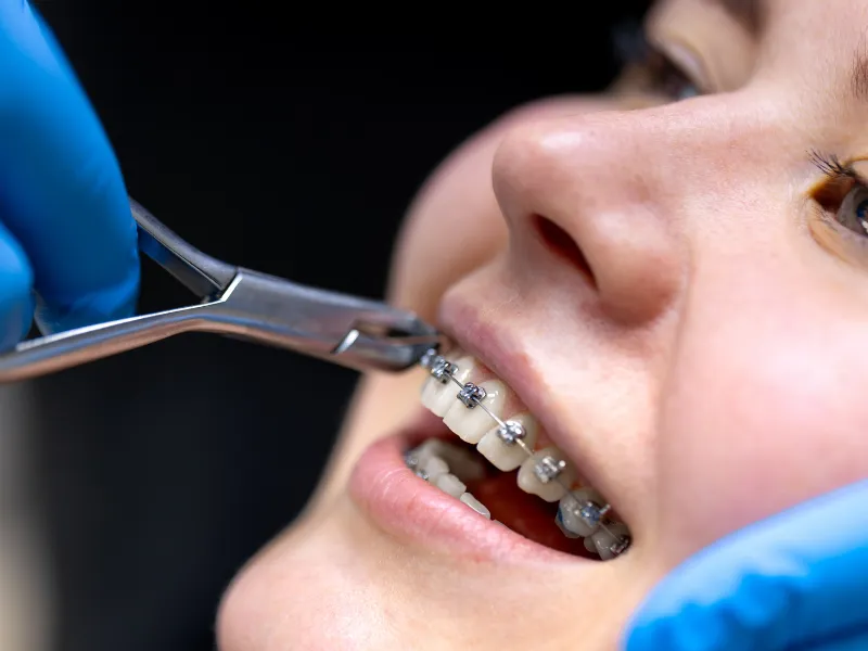 Orthodontic Braces at Floss & Gloss Aesthetics