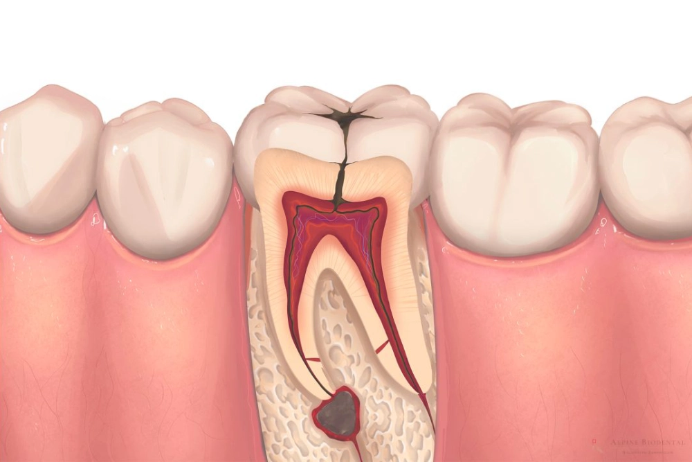 Root Canal Treatment at Floss & Gloss Aesthetics