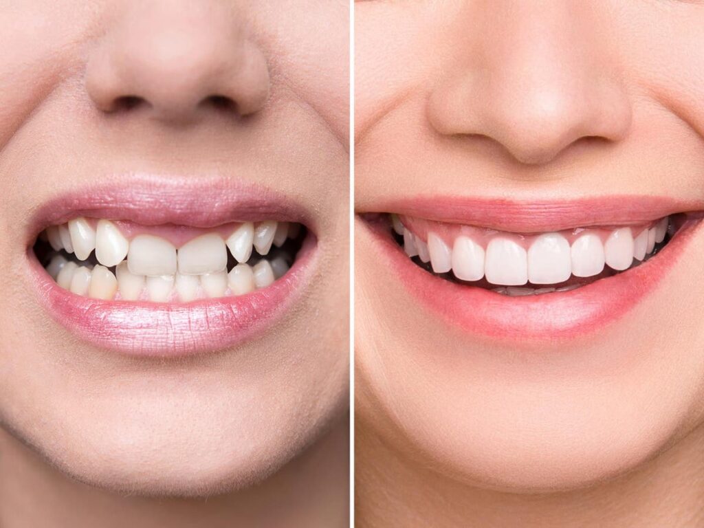 Smile Design at Floss & Gloss Aesthetics