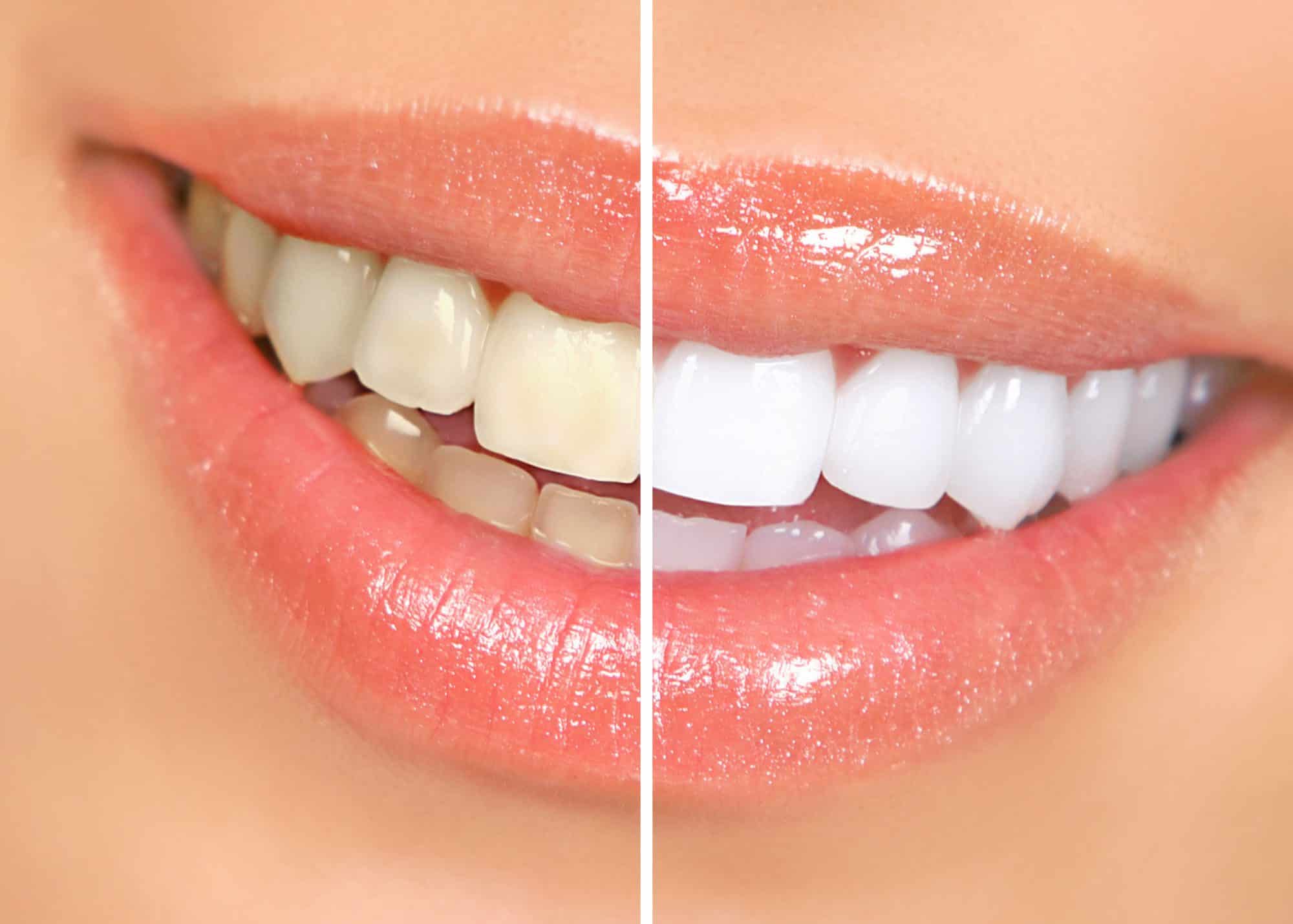 Teeth Whitening at Floss & Gloss Aesthetics
